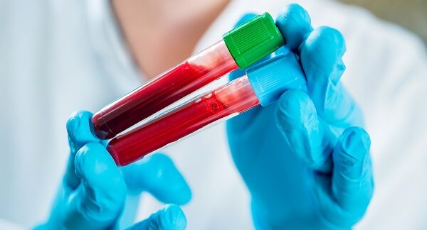 mejores hematólogos - uno de los mejores hematólogos, sostiene dos muestras de sangre que deben ser examinadas