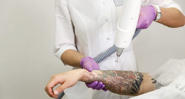 en uno de los centros de eliminación de tatuajes, una especialista le realiza una remoción de tatuajes a paciente